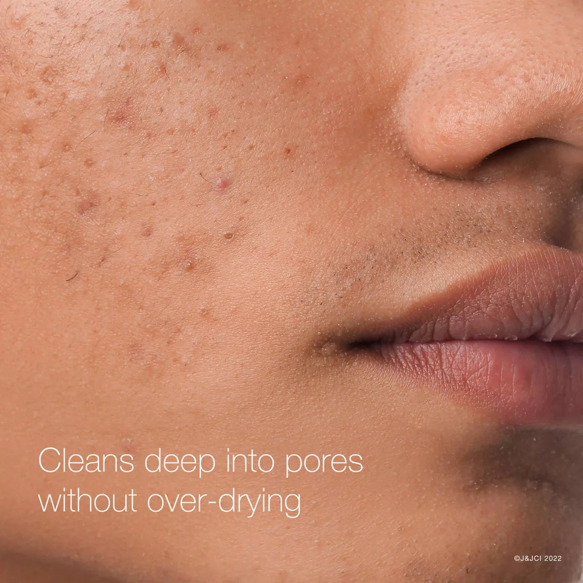 Neutrogena Rapid Clear Maximum Strength Acne Face Pads for Acne-Prone Skin - 60 Ct